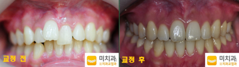 교정 전 후 사진입니다.