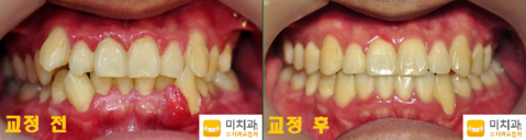 교정 전 후 사진입니다.