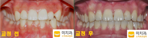 교정 전 후 사진입니다.