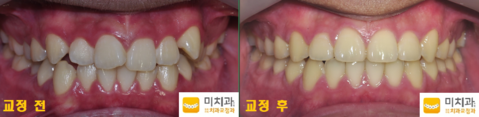 교정 전 후 사진입니다.