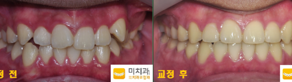 교정 전 후 사진입니다.