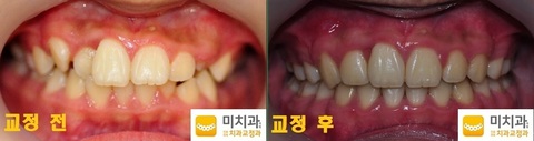 교정 전 후 사진입니다.