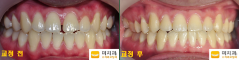 교정 전 후 사진입니다.