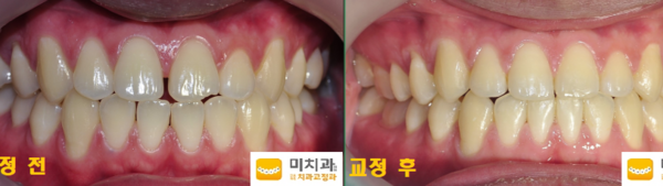교정 전 후 사진입니다.