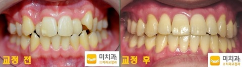 교정 전 후입니다.