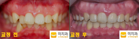 교정 전 후 사진입니다.