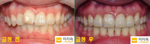 교정 전 후 입니다.
