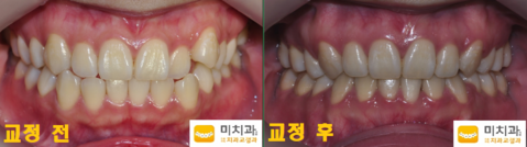 교정 전 후 사진입니다.