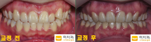 교정 전 후 사진입니다.