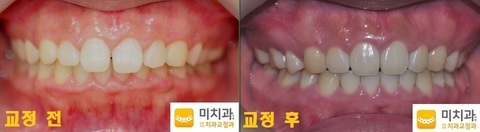 교정 전 후 사진입니다.